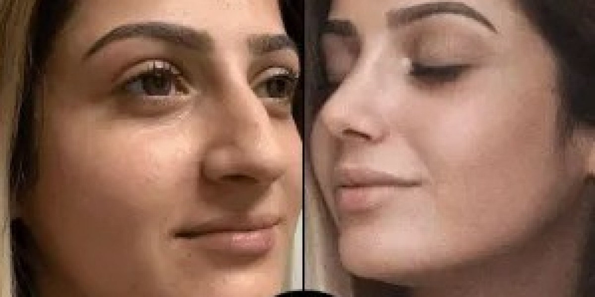 Before and After: My Results with Best Plastic Surgeon in Dubai