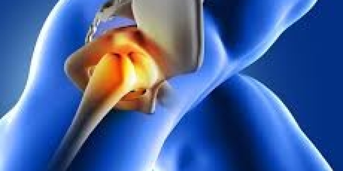 Hip Replacement Surgery: How to Prepare for a Smooth Recovery