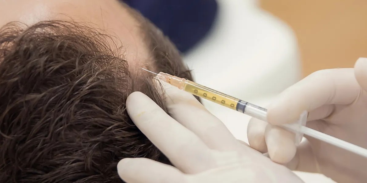 PRP Hair Treatment Cost in Delhi – A Complete Guide