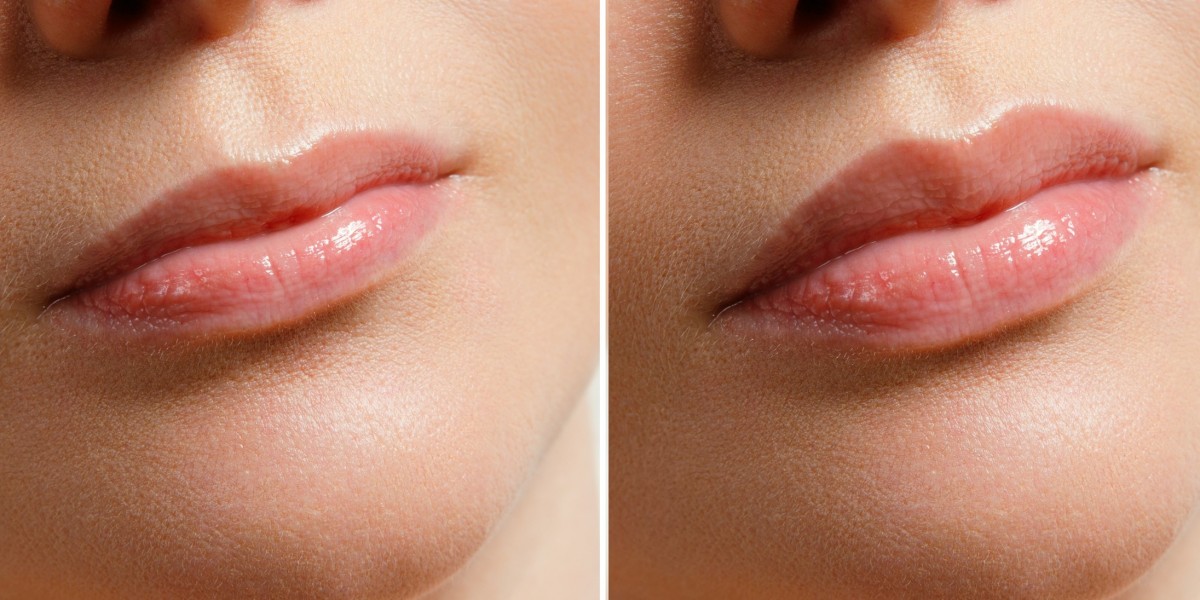 Lip Filler Myths Debunked – What’s Real and What’s Not